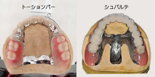 トーションバー、シュパルテ